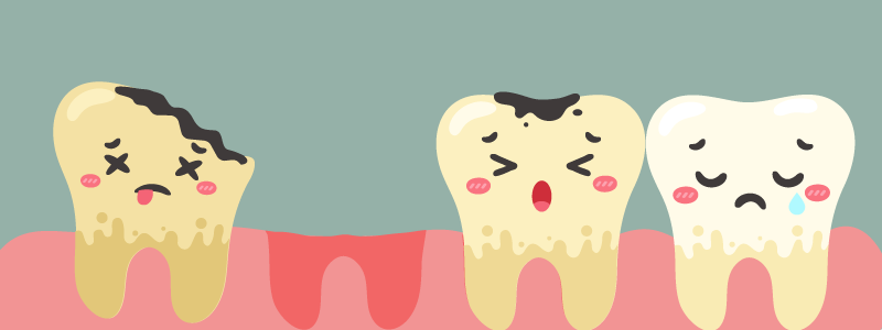 曾梓豪醫師指出，除了重度牙周病導致外，嚴重齲齒或意外事故等都會造成缺牙問題，一般都會盡快以假牙或植牙等治療方式來解決，除了老年人缺牙情況嚴重，根據統計，台灣12到64歲區間中，缺牙率也高達43%，顯示無論任何年齡層都必須關注缺牙問題，避免長期缺牙影響身體健康。